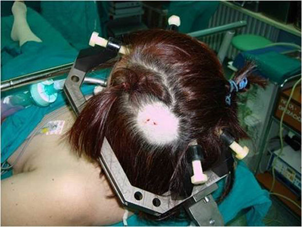 Разговор са хирургом током операције мозга